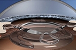 Innovative Dual-Lens Cataract Surgery in Sydney | For the Best Cataract Surgery – Dr Alison Chiu