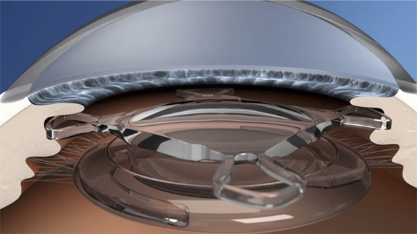 Illustration of dual-lens cataract surgery (PresbyDuet technique), showing the monofocal IOL in the capsular bag plus a removable add-on lens in the sulcus - performed by Dr Alison Chiu, a leading cataract surgeon in Sydney, Australia.