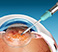 Custom Cataract Surgery