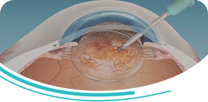 Custom Cataract Surgery