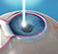 Refractive Surgery